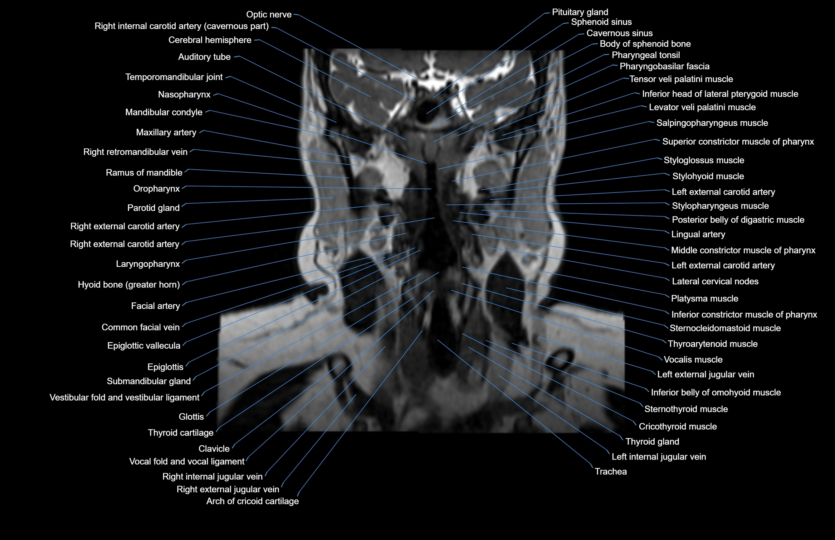 Neck coronal cross sectional MRI anatomy 3T MRI  image-img-00001-00041.webp